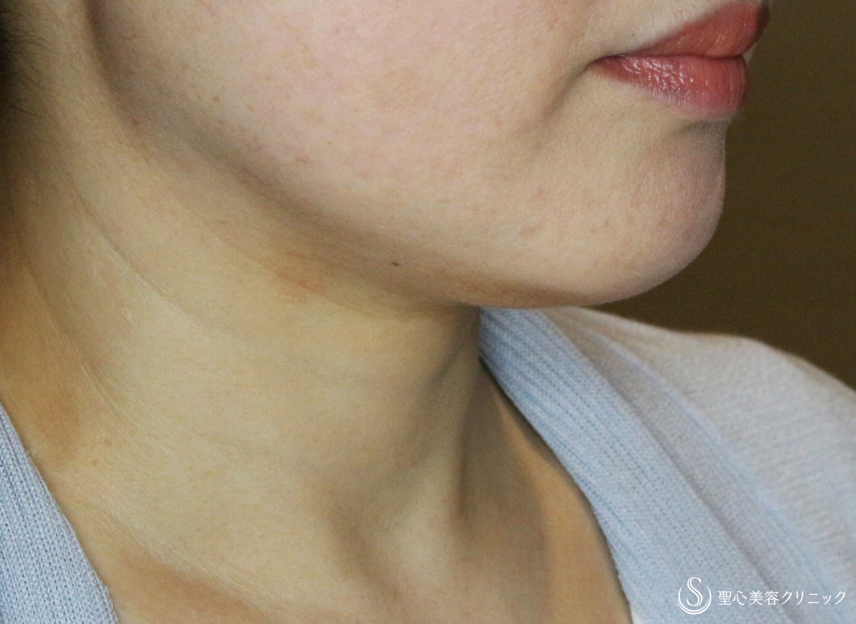 【50代女性・切らずに二重アゴを解消】「輪郭注射」単独（3回後） After 