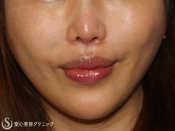 【20代女性・鼻下の長さを改善】鼻下短縮術（リップリフト）（1ヶ月後） After 