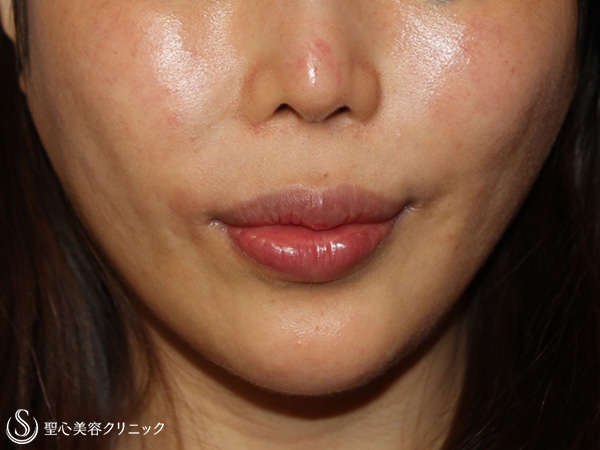 【20代女性・鼻下の長さを改善】鼻下短縮術（リップリフト）（1ヶ月後） Before 