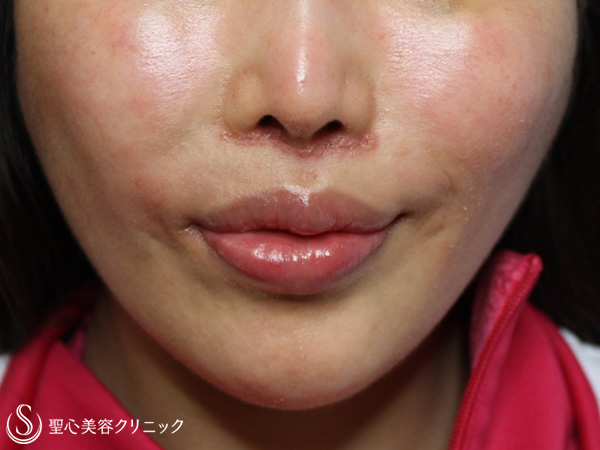 【20代女性・鼻下の長さを改善】鼻下短縮術（リップリフト）（1ヶ月後） After 