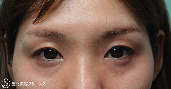 【30代女性・疲れて見える目（くぼみ目）の改善】プレミアムPRP皮膚再生療法（6ヶ月後） After 