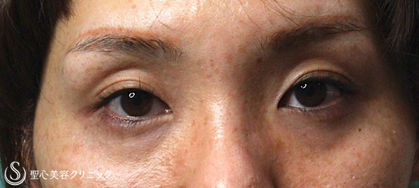 【30代女性・疲れて見える目（くぼみ目）の改善】プレミアムPRP皮膚再生療法（6ヶ月後） Before 