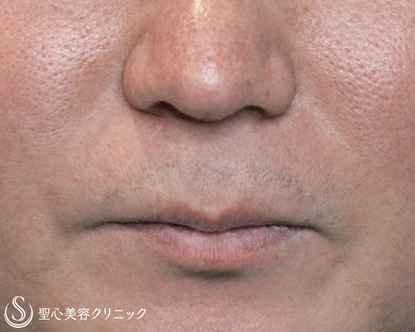 30代男性 鼻の下を短く リップリフト １ヶ月 症例写真 美容整形 美容外科なら聖心美容クリニック