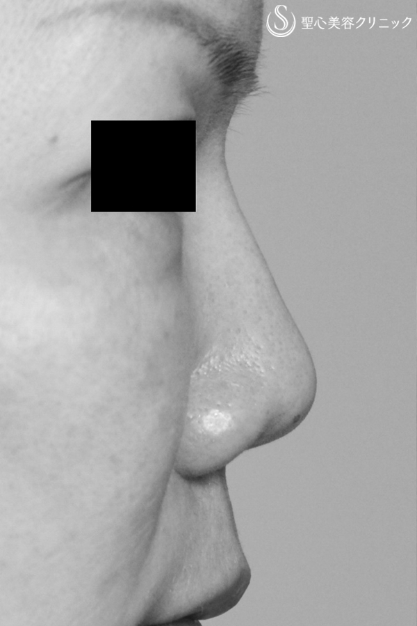 【40代女性・鼻尖がやや上を向く印象を改善】耳介軟骨移植による鼻先形成 Before 