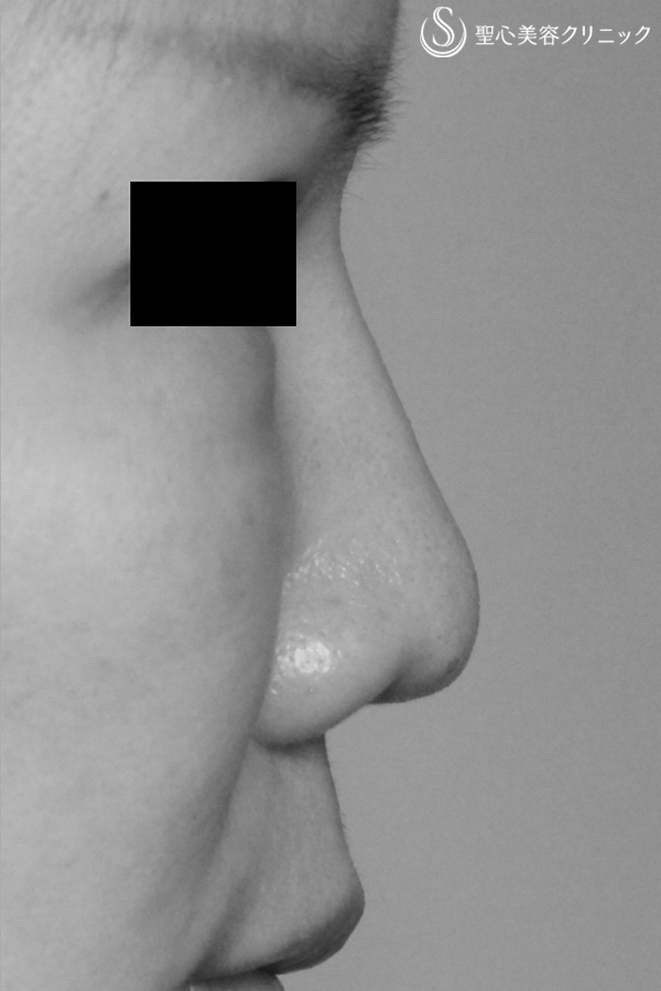 【40代女性・鼻尖がやや上を向く印象を改善】耳介軟骨移植による鼻先形成 After 