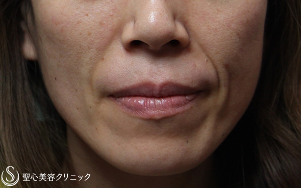 【40代女性・気になるほうれい線を改善】プレミアムPRP皮膚再生療法（2年後） Before 