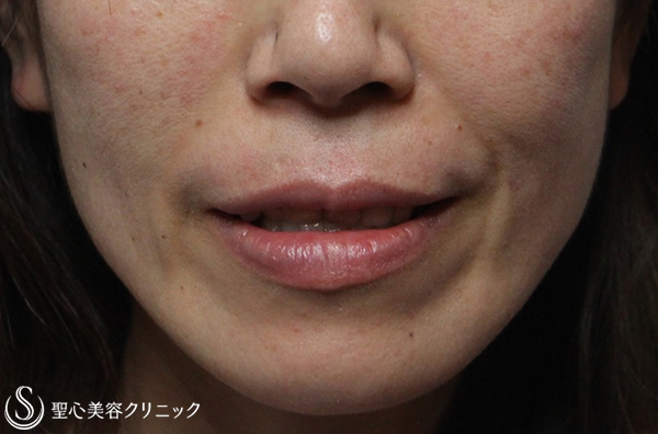 【40代女性・気になるほうれい線を改善】プレミアムPRP皮膚再生療法（2年後） After 