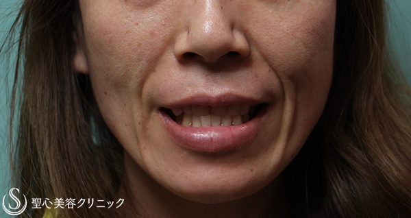 【40代女性・気になるほうれい線を改善】プレミアムPRP皮膚再生療法（2年後） Before 