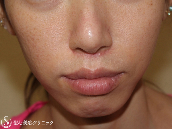 【30代女性・頬を女性らしくふっくらと】ヒアルロン酸注入（3週間後） After 