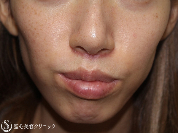 【30代女性・頬を女性らしくふっくらと】ヒアルロン酸注入（3週間後） Before 