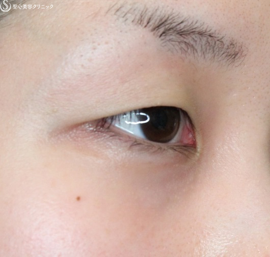 【20代女性・重たい一重まぶたを改善】マイクロメソッド＋α（術直後） Before 