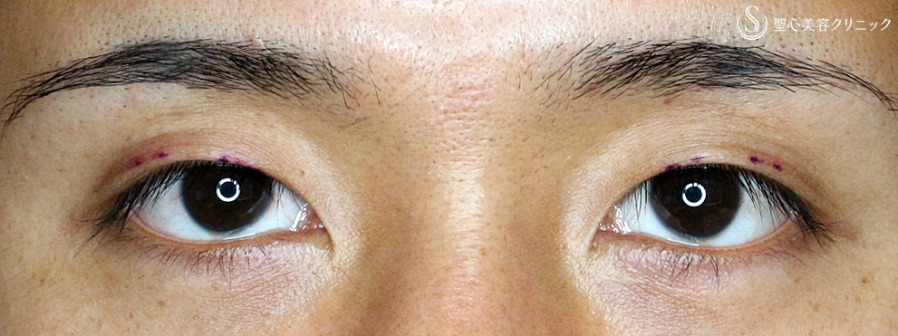 【20代男性・切れ長イケメン二重をつくる】マイクロメソッド+α法（2ヶ月後） Before 