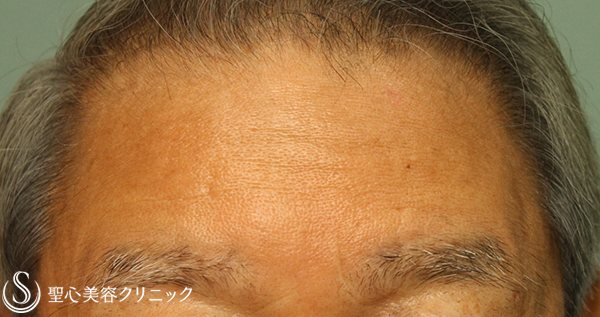 【70代男性：額・眉間のしわ】プレミアムPRP皮膚再生療法 2年経過 After 
