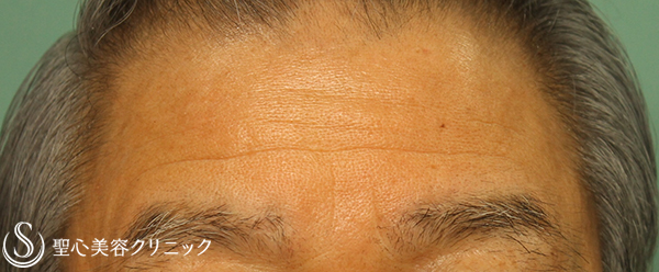 【70代男性：額・眉間のしわ】プレミアムPRP皮膚再生療法 2年経過 Before 