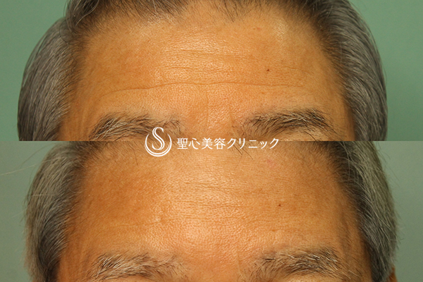 【70代男性：額・眉間のしわ】プレミアムPRP皮膚再生療法 2年経過 After 