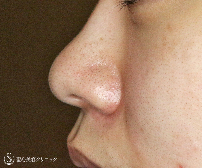 【20代女性・正面から鼻の穴が見える】小鼻縮小術+α法（6ヶ月後）札幌院 Before 
