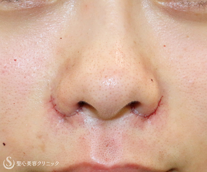 【20代女性・正面から鼻の穴が見える】小鼻縮小術+α法（6ヶ月後）札幌院 Before 