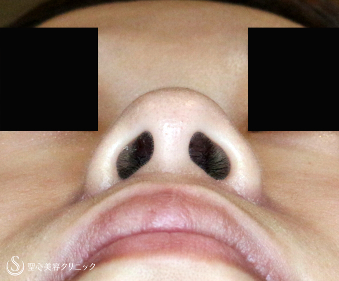 【20代女性・正面から鼻の穴が見える】小鼻縮小術+α法（6ヶ月後）札幌院 After 