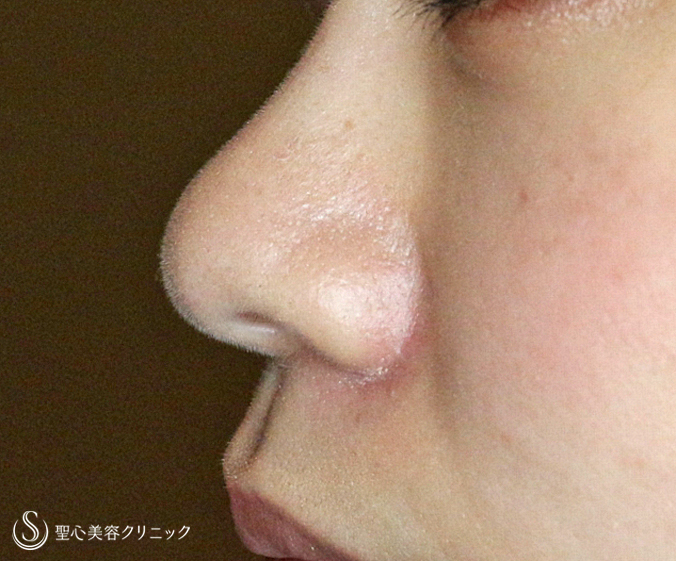 【20代女性・正面から鼻の穴が見える】小鼻縮小術+α法（6ヶ月後）札幌院 After 