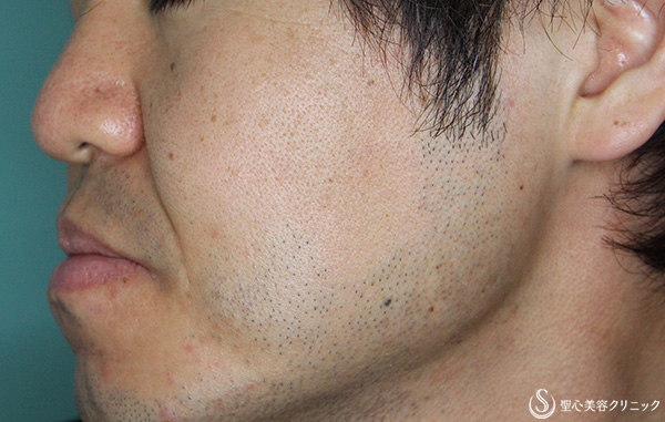 【30代男性・ヒゲ脱毛】医療脱毛（半年・5回照射） Before 