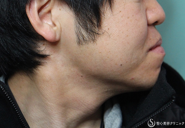 【30代男性・ヒゲ脱毛】医療脱毛（半年・5回照射） After 