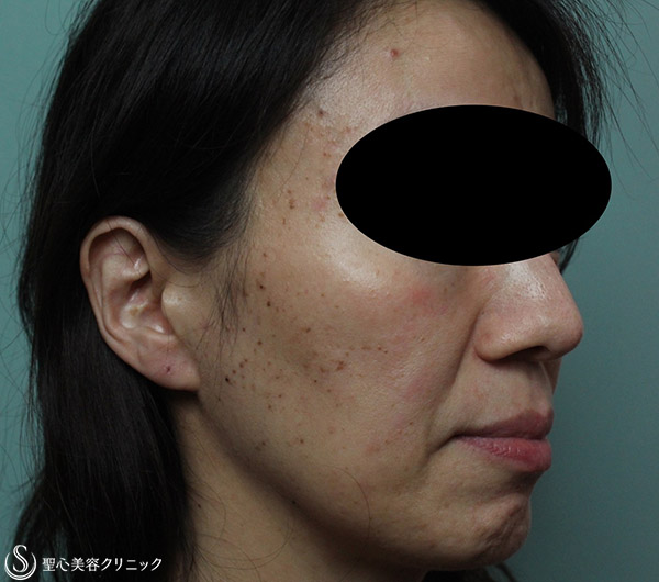【女性・顔のブツブツやシミをキレイに】老人性疣贅、脂漏性角化症治療（1年後） Before 