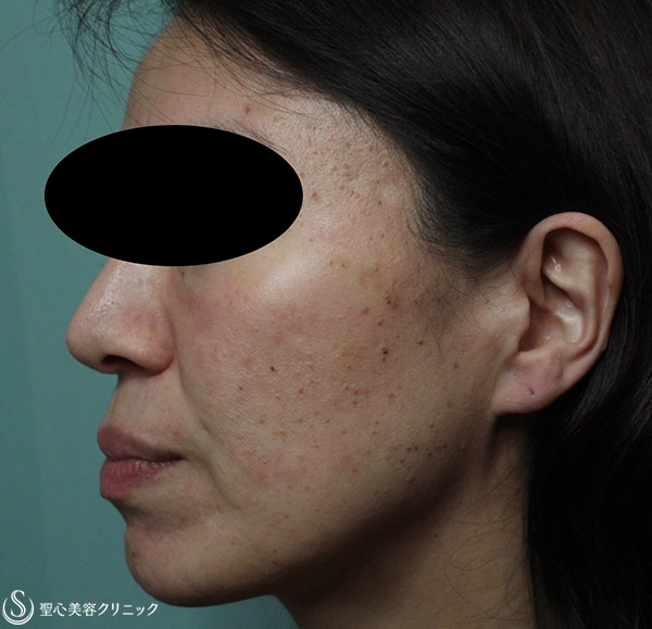 【女性・顔のブツブツやシミをキレイに】老人性疣贅、脂漏性角化症治療（1年後） Before 