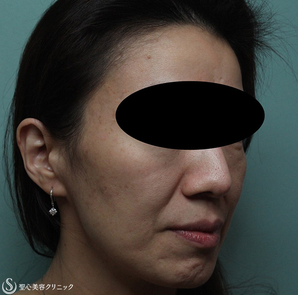 【女性・顔のブツブツやシミをキレイに】老人性疣贅、脂漏性角化症治療（1年後） After 