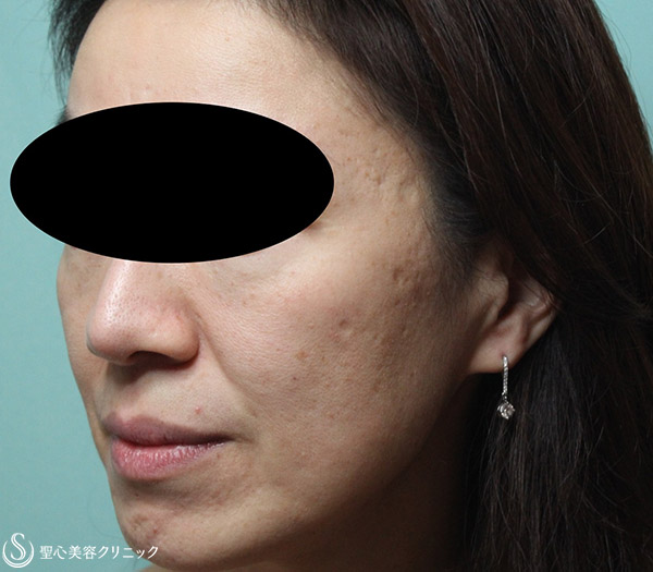 【女性・顔のブツブツやシミをキレイに】老人性疣贅、脂漏性角化症治療（1年後） After 