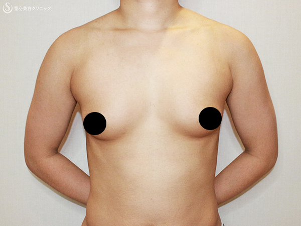 【10代女性・性同一性障害（FTM）】乳腺切除+ベイザー脂肪吸引（1年後） Before 