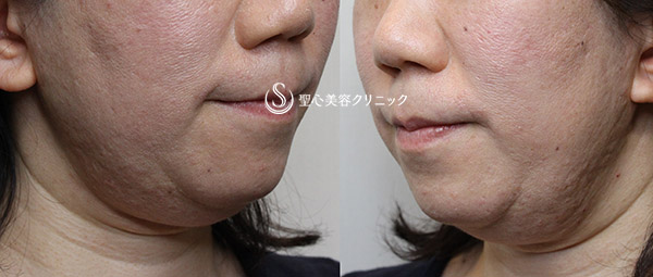 【30代女性・あご下のもたつきをスッキリ】輪郭注射（10cc・5回注射後） Before 