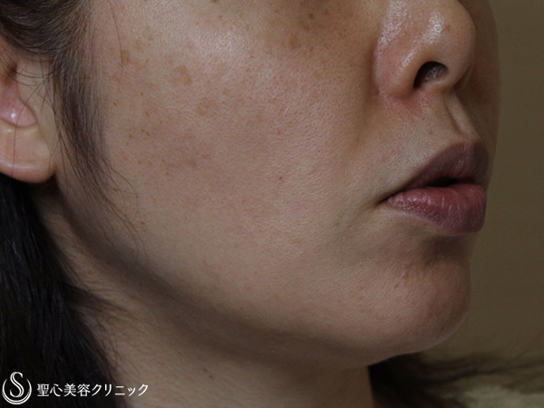 【40代女性・頬のたるみをスッキリ】ドクターハイフ（ウルセラシステム）（1ヶ月後） Before 