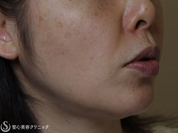 【40代女性・頬のたるみをスッキリ】ドクターハイフ（ウルセラシステム）（1ヶ月後） Before 
