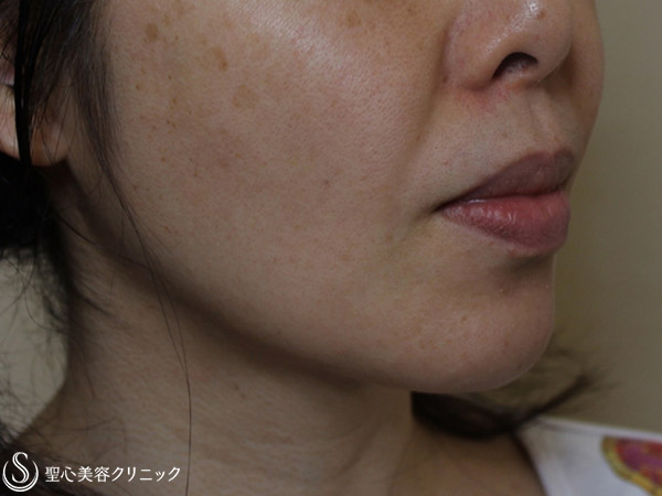 【40代女性・頬のたるみをスッキリ】ドクターハイフ（ウルセラシステム）（1ヶ月後） After 