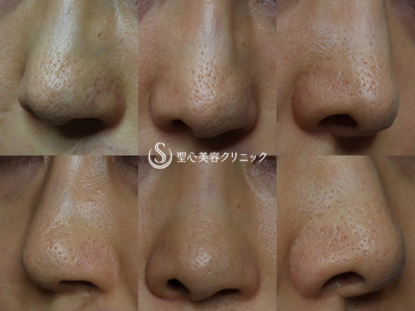 【40代女性・鼻の毛穴改善】アグネス（1回処置・1ヶ月後） After 