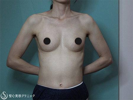 【40代女性・自然な形でバスト5cmアップ】セリューション豊胸術（半年後） After 