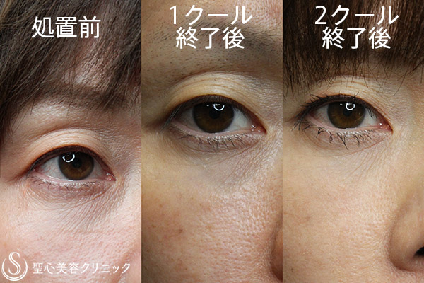 【40代女性・目の下小じわ、毛穴の改善】ネオジェンスパ（10回治療後） After 