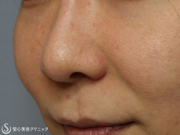 【30代女性・小鼻の毛穴治療】アグネス（2回治療後） Before 