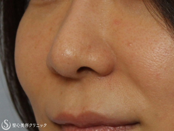 【30代女性・小鼻の毛穴治療】アグネス（2回治療後） After 