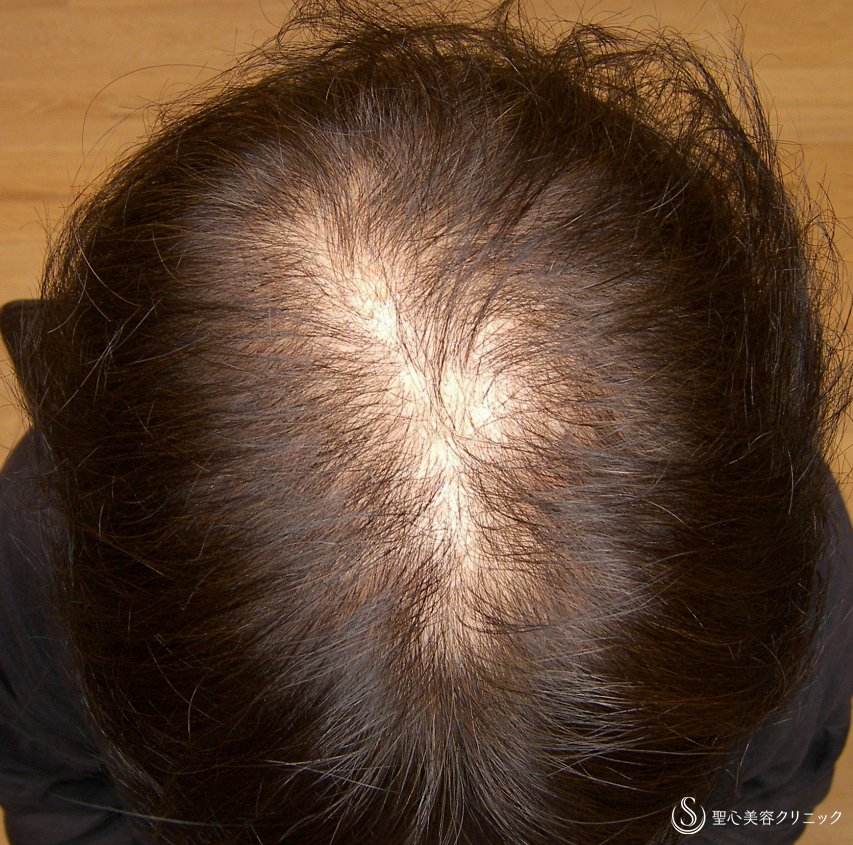 【50代女性・びまん性脱毛】グロースファクター毛髪再生療法（8回後） Before 