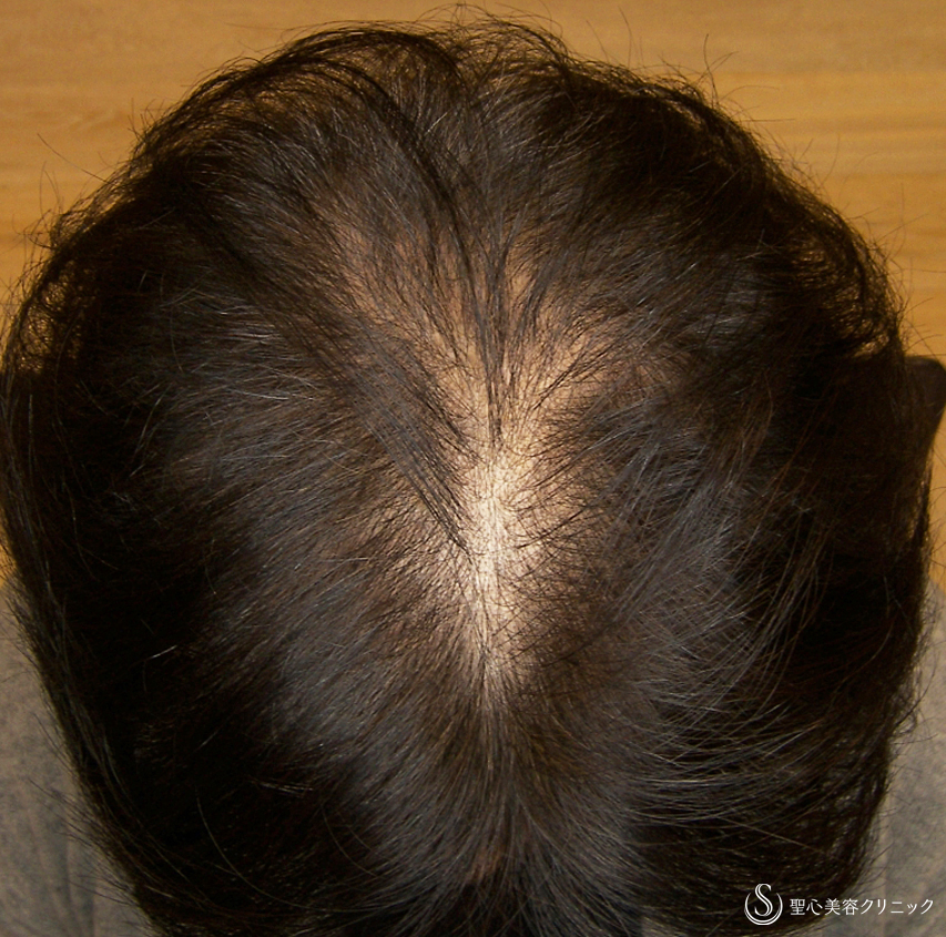【50代女性・びまん性脱毛】グロースファクター毛髪再生療法（8回後） After 