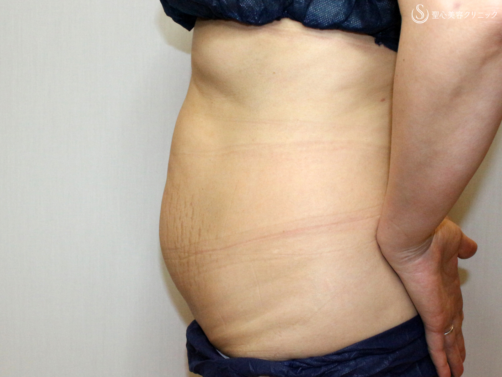 【49才女性・切らないお腹の痩身】リポセル・モニター（3ヶ月後） Before 