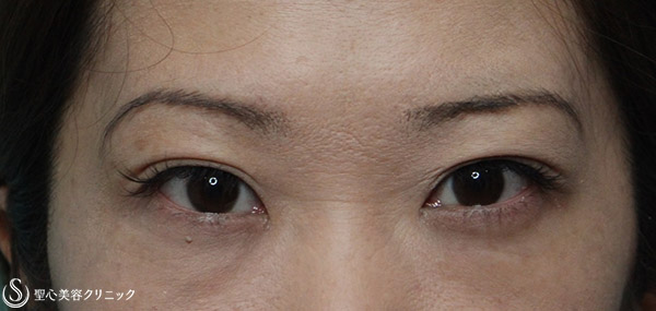 【女性・他院の額ボトックスで重くなった瞼を改善】他院修正（1週間後） Before 