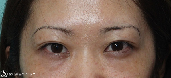【女性・他院の額ボトックスで重くなった瞼を改善】他院修正（1週間後） After 