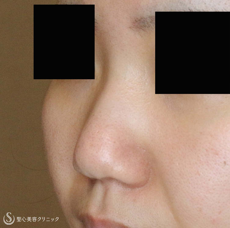【20代女性・自然な鼻筋】鼻シリコンプロテーゼ単独（2年後） Before 