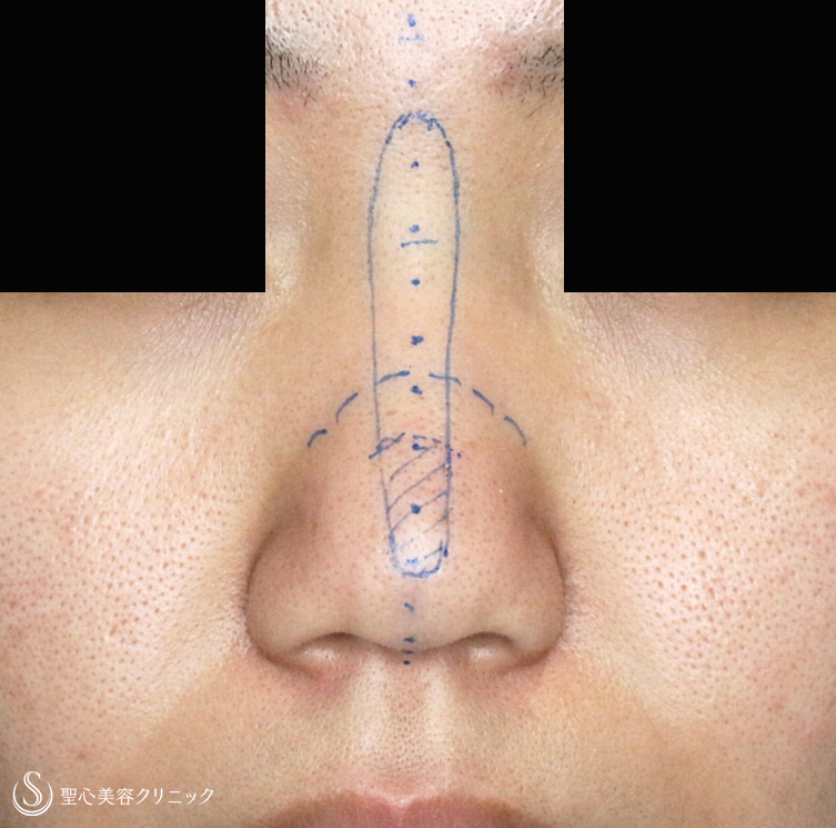 【20代女性・自然な鼻筋】鼻シリコンプロテーゼ単独（2年後） Before 