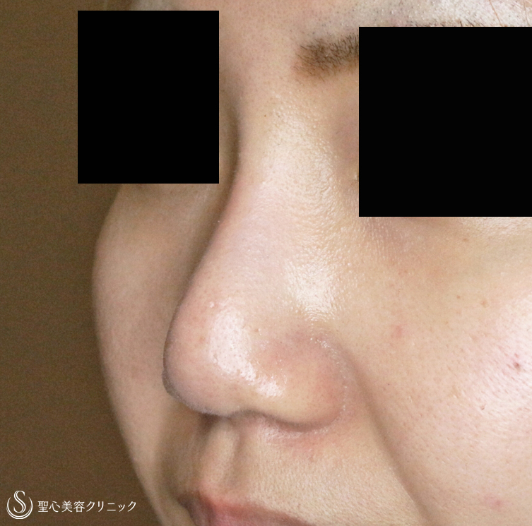 【20代女性・自然な鼻筋】鼻シリコンプロテーゼ単独（2年後） After 