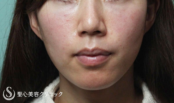 【30代女性・ほうれい線、目の下、頬の改善】プレミアムPRP（施術直後と2ヶ月後） After 