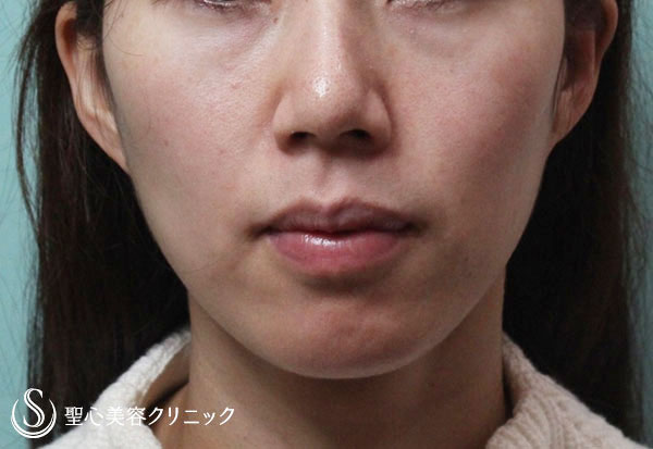 【30代女性・ほうれい線、目の下、頬の改善】プレミアムPRP（施術直後と2ヶ月後） Before 