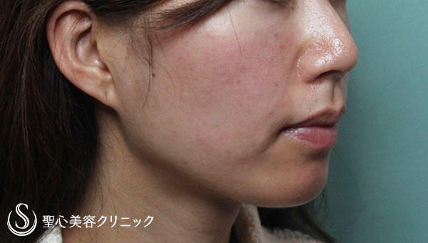 【30代女性・ほうれい線、目の下、頬の改善】プレミアムPRP（施術直後と2ヶ月後） After 